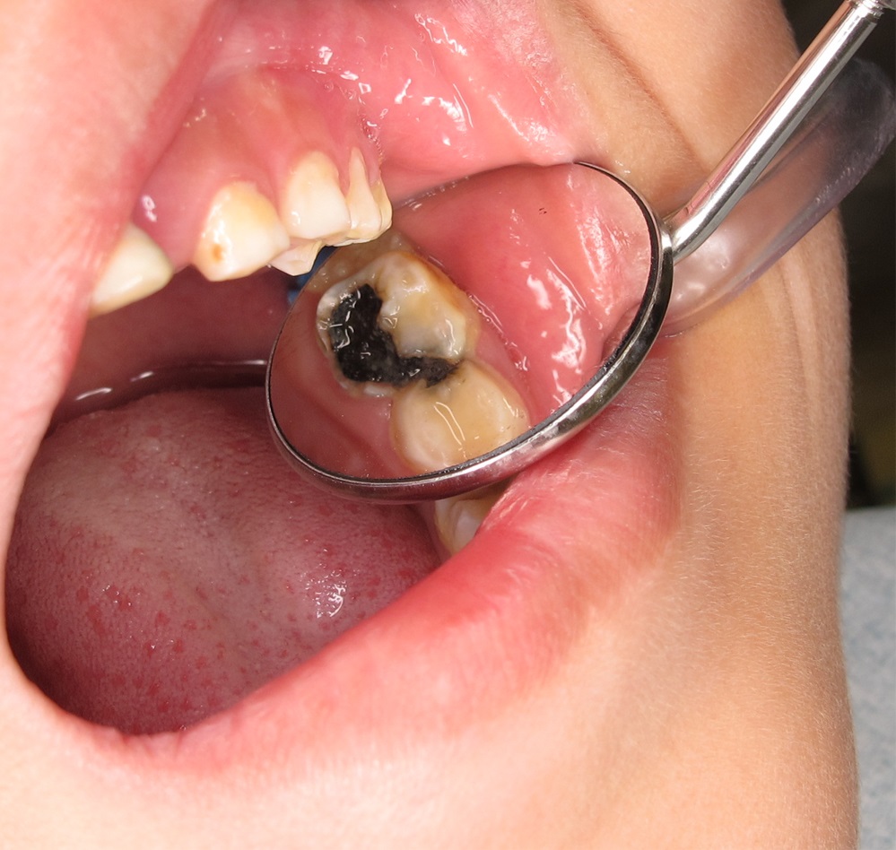 涂抹溶液后，蛀坏的牙齿组织会硬化及永久变黑。