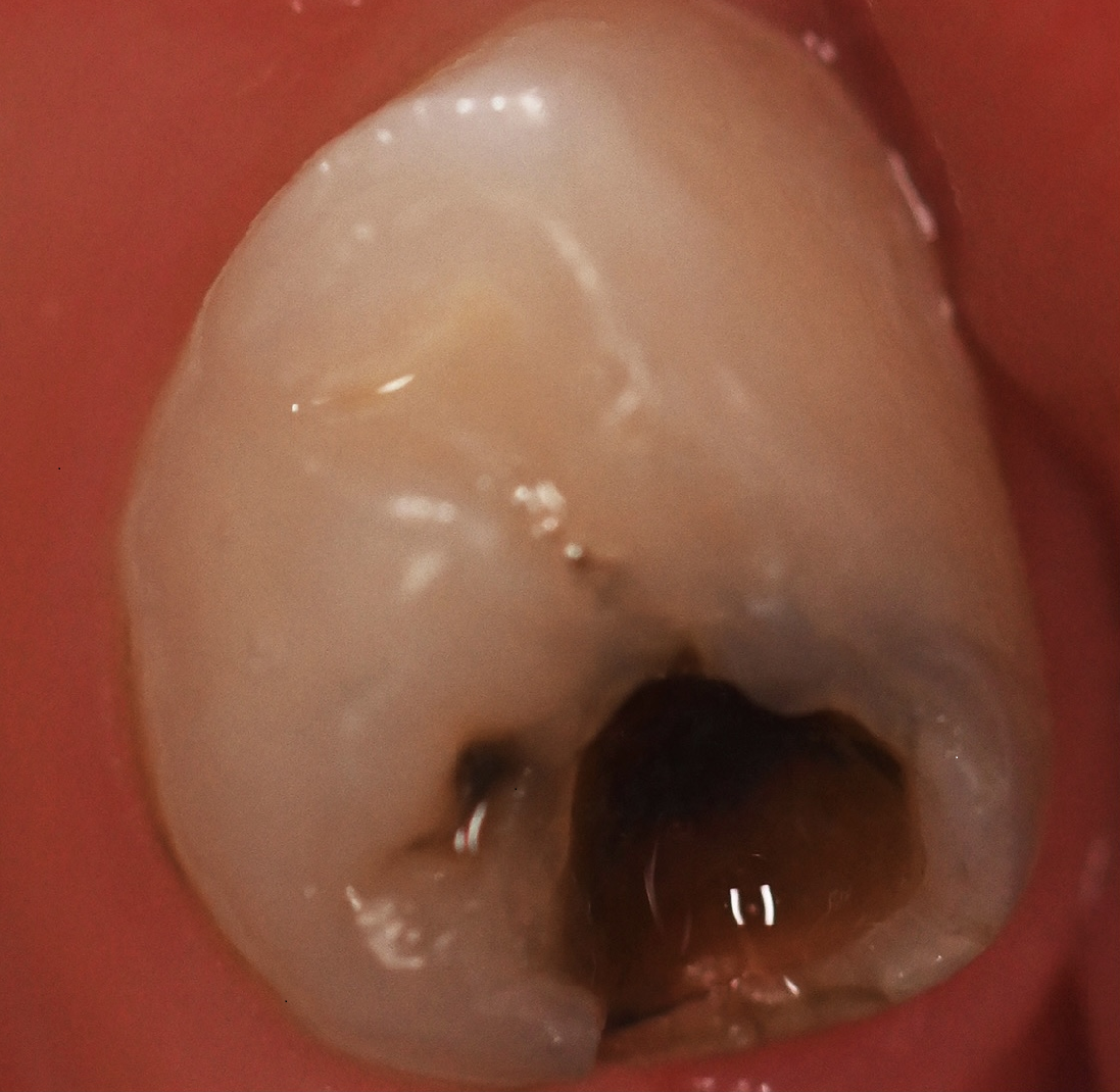 牙齿的蛀坏部分在涂抹氟化氨银溶液前和涂抹后的不同状况。（涂抹后）