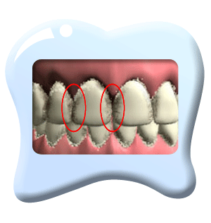 图中所见是上下排前牙，牙齿的邻面都积藏不少牙菌膜。