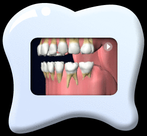 Animation of the process of replacement of deciduous teeth by permanent teeth.