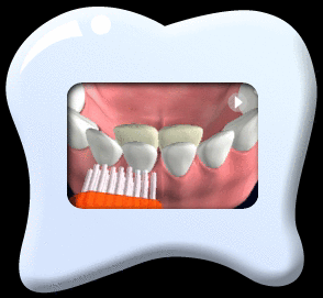 Animation of cleaning the mobile deciduous teeth gently.