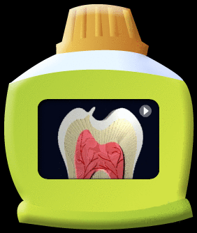 动画所见是梁氏小臼齿凸出的部分折断后导致牙髓发炎的过程。