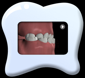 Animation showing teeth with reversed bite.