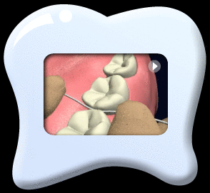 Animation  continued from the previous motion that the floss is wrapped around a tooth making a “C” shape and is gently slid up and down against the tooth.  Then the floss is wrapped around another adjacent surface of the tooth to repeat the up and down motions.