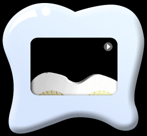 Animation of the longitudinal section of a tooth crown with the acids produced by bacteria, resulting in enamel discoloration indicating mineral loss from the enamel.