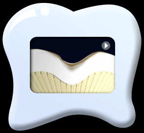 Animation showing the longitudinal section of a tooth at its initial stage of tooth decay.  An appropriate amount of fluoride has been applied to the decay resulting in the remineralization of the decayed portion.