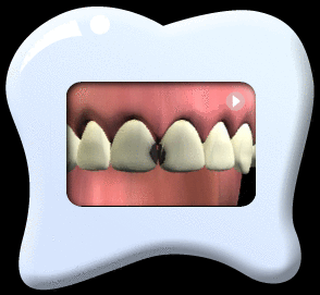Animation showing the use of dental instruments to remove the decayed portion  the two upper incisors and filling with composite.