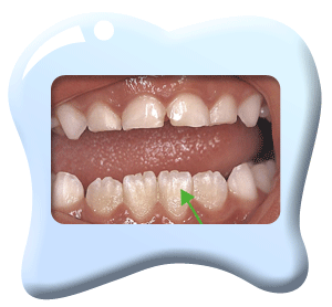 图中所见是在咬合位置呈锯齿状的下排门牙。