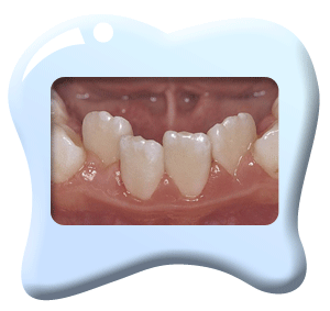    Photograph of lower incisors that are not well aligned.
