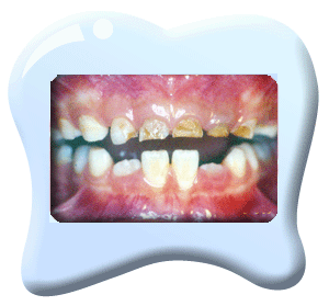 Photograph of a set of teeth with the upper teeth suffering from severe early childhood caries.尸