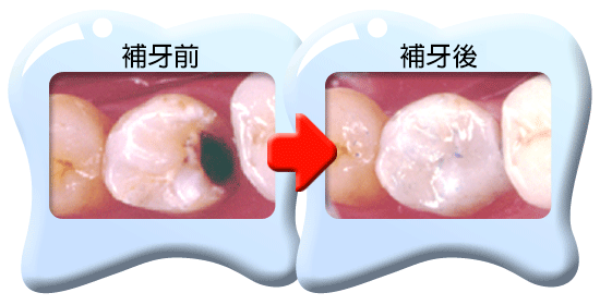 圖中所見是蛀壞的牙齒以複合樹脂填補之前和之後的外貌。