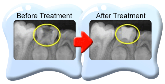 Photograph of two x-ray films indicating showing a deciduous molar with partial removal of pulp tissues before and after treatment.