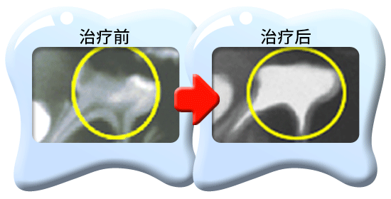图中所见是两张X光片，显示一颗接受清除全部牙髓的治疗的乳臼齿，分别是治疗前和治疗后的情况。