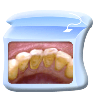 图中所见是洗牙前，下排前牙都积有若干牙石。