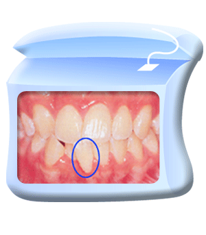 图中所见是为配合牙齿矫正治疗而需要拔掉的牙齿。