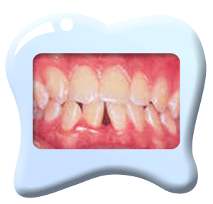 图中所见是为配合牙齿矫正治疗而需要拔掉的牙齿已给拔去。