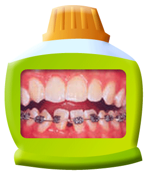 图中所见是下排牙齿都镶有矫齿所需的配件，是正处矫齿疗程中。