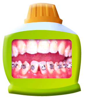 圖中所見是上下排前牙，下排牙齒表面都附著牙齒矯正器