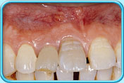 圖中所見是原本呈灰黑色的正門牙接受根管治療後，灰黑色褪去，呈象牙白色。