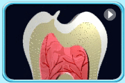 Animation showing the process of pulp infection caused by the fractured projected tooth structure of a Leong's premolar.