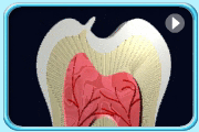 Animation showing the use of dental material to strengthen the projected tooth structure of a Leong's premolar.