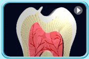 Animation showing the removal of the projected tooth structure of a Leong's premolar followed by the restoration with dental material.