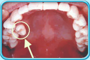 图中所见是乳齿过早脱落，导致恒齿在不适当位置长出。