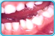 图中所见是下排乳齿侧门牙和犬齿连在一起生长，形成融合牙。