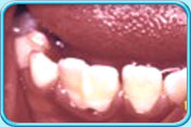 Photograph of a missing permanent lateral incisor in the lower set of teeth.