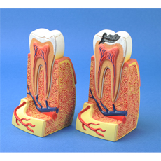 健康與蛀牙的牙齒模型