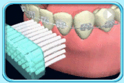 動畫片段所見是以牙刷清潔戴有矯齒器的下排牙齒。