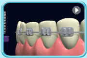Animation showing the use of interdental brush to brush the area between the orthodontic appliance and lower teeth in up and down motion.