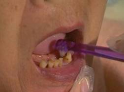 Photograph showing how the caregiver brushes the elderly's teeth with a single-tuft toothbrush.