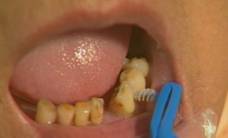 Photograph showing the use of interdental brush to clean wide interdental space for the elderly.