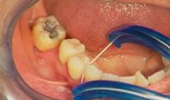 Photograph showing the use of floss holder to clean narrow interdental space for the elderly.