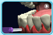 Animation showing the use of interdental brush to clean the adjacent tooth surfaces with wide gap.