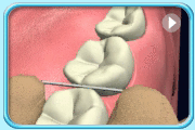 Animation showing a sawing motion to pull the floss into the interdental space of lower teeth.