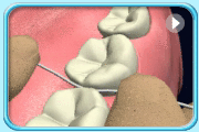 Animation continued the previous motion that the floss is wrapped around a tooth making a “C” shape and is gently slid up and down against the tooth.  Then the floss is wrapped around another adjacent surface of the tooth to repeat the up and down motions.