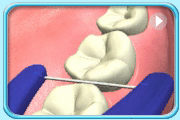 Animation showing the floss portion of a floss holder being moved left and right between two teeth and slowly slid towards the gingival margin.