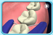 Animation continued from the previous motion showing the floss portion of the floss holder being wrapped around another adjacent tooth surface of the same tooth making a “C” shape.