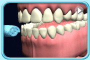 Animation showing how to use one side of the teeth to bite on a supplementary tool and then place a tooth brush into the mouth to brush the other side of the teeth.