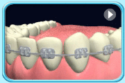 Animation of pushing the stiffened end of the floss through the space between the teeth and the orthodontic appliance.