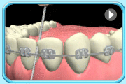 Animation showing  the floss being gently pulled into the interdental space by a sawing motion.