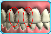Photograph showing that abundant plaque is accumulated on the adjacent surfaces of upper and lower front teeth.