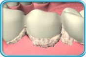 图中所见是牙桥底部积藏着牙菌膜的情况。