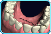 Photograph showing a fractured denture.