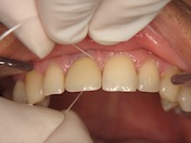 Photograph showing the cleaning of an adjacent surface of a tooth with dental floss.