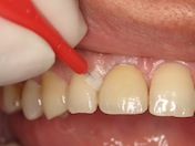 Photograph showing the cleaning of interdental surfaces with a interdental brush.