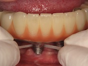 Photograph showing the cleaning of abutment and the gap between the bridge and the gum with a superfloss.