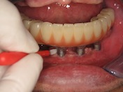 Photograph showing the cleaning of abutment and the gap between the bridge and the gum with a interdental brush.